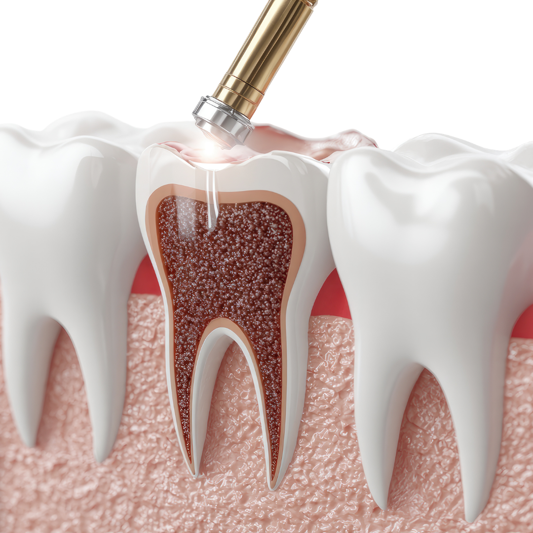 Root Canal Andheri East